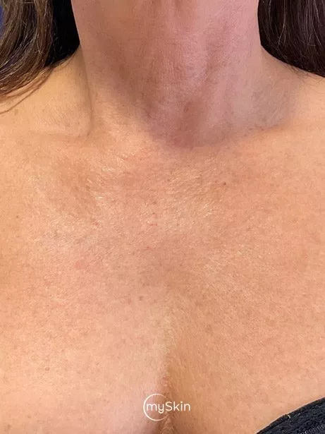 Picture after treatment with the nordlys swt