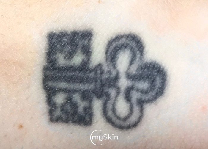 small tattoo before treatment