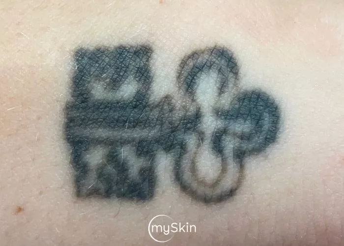 small tattoo after treatment