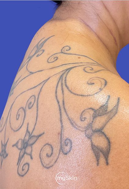 Eliminación de tatuajes con el láser Picoway