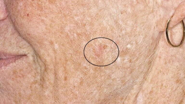 Myskin Hautkrebs Durch Fr herkennung Dauerhaft Heilen myskin-hautkrebs-durch-fr-herkennung-dauerhaft-heilen