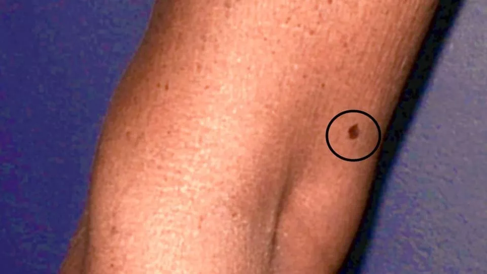 Melanom auf Arm