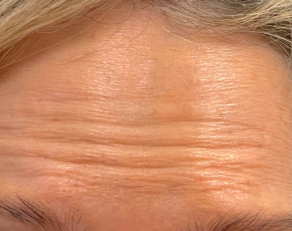 Wrinkels on forehead of woman