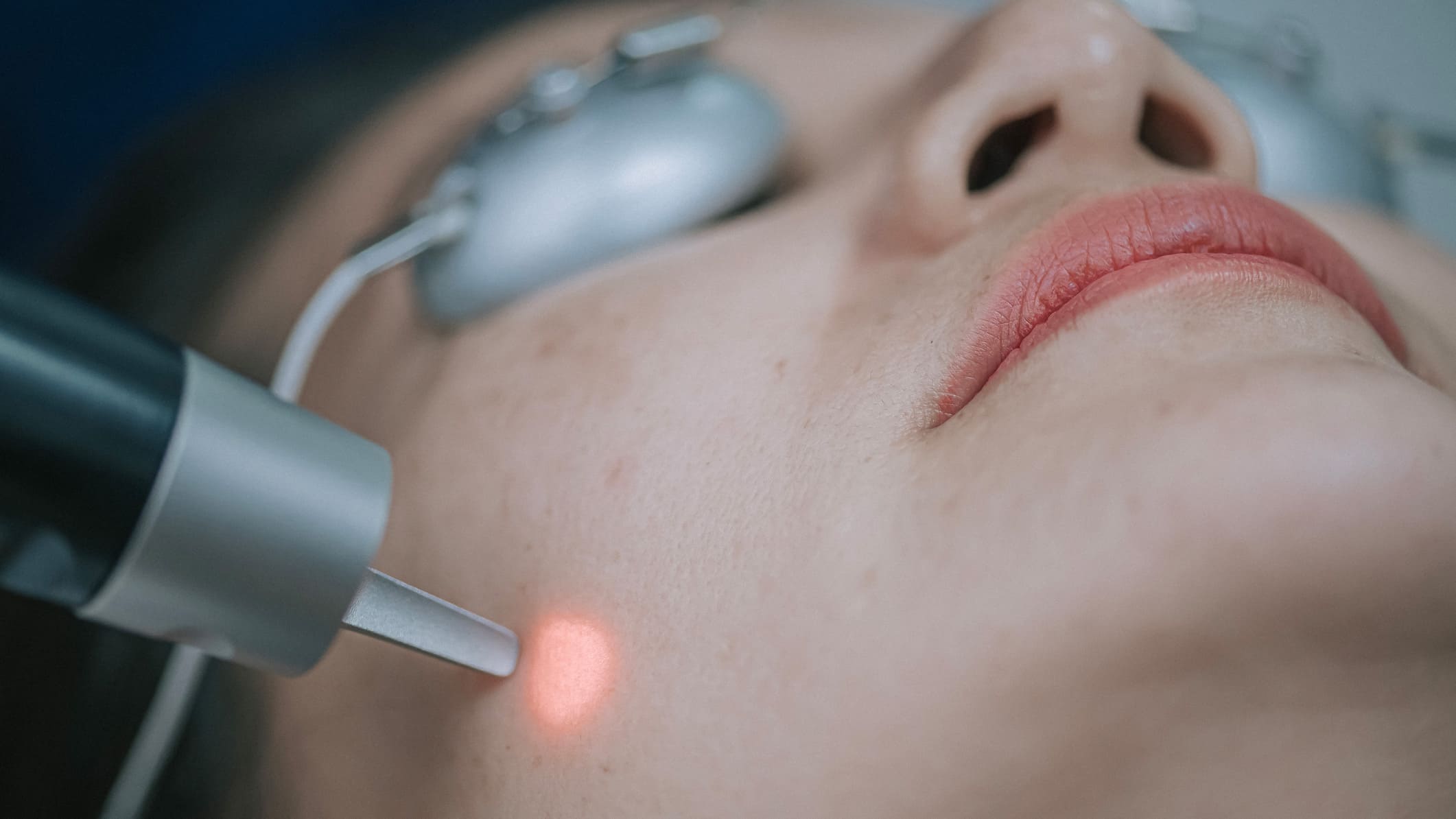 Gesicht einer Frau wird mit Laser behandelt