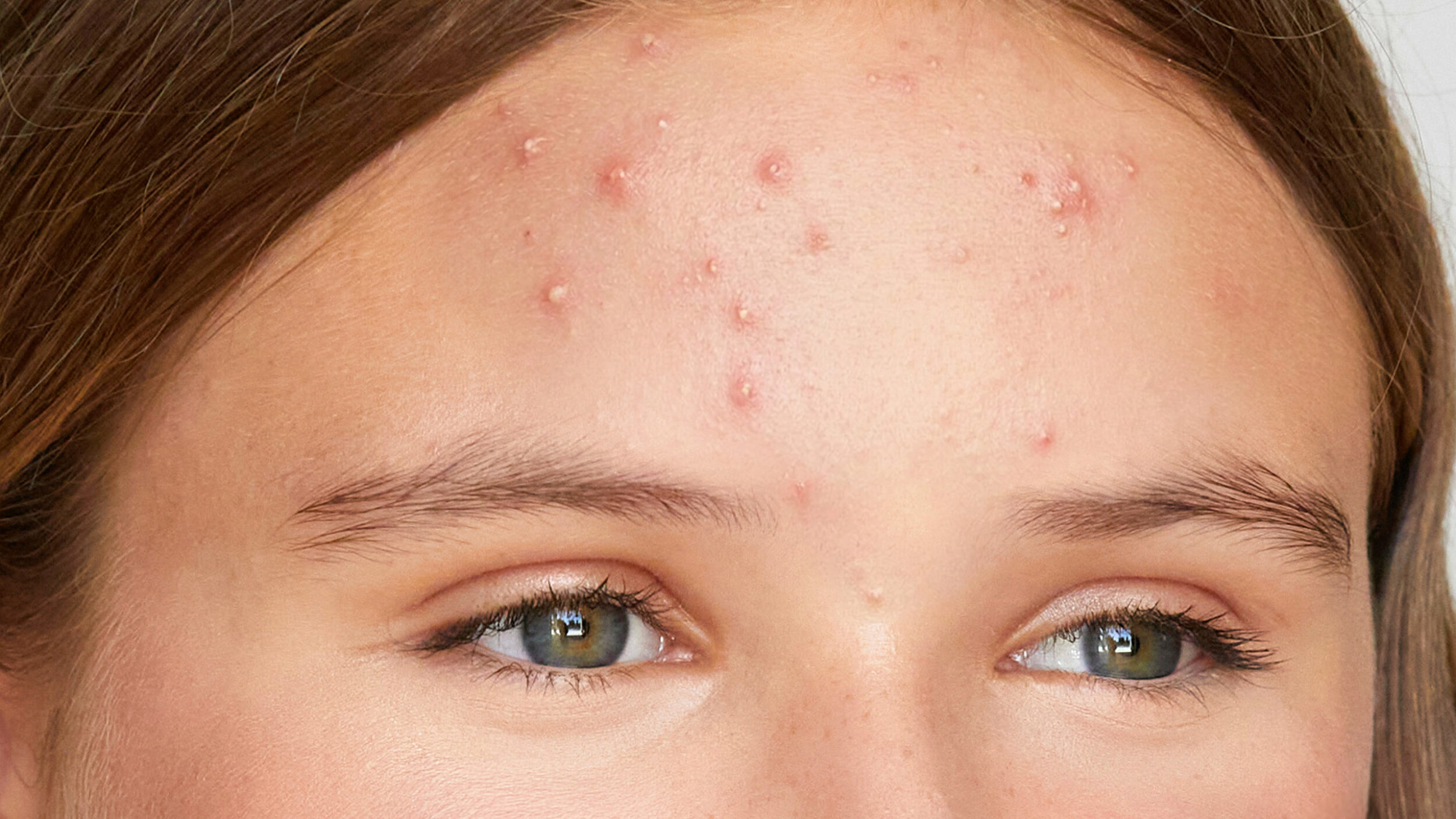Close-up of a teenage girl with acne-prone skin and inflammatory blemishes on the forehead.