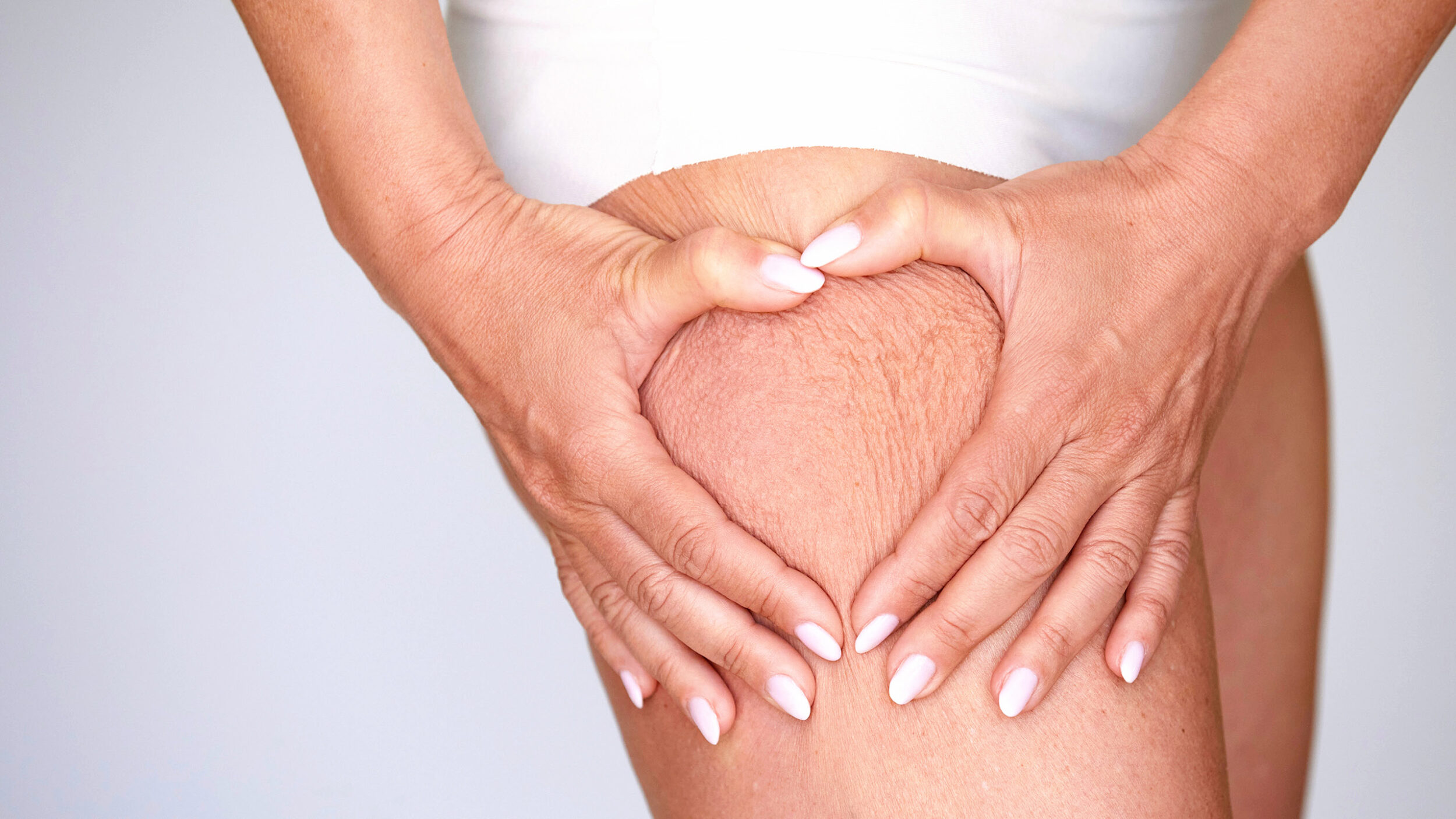 Close-up of cellulite on the thigh before aesthetic cellulite treatment.
