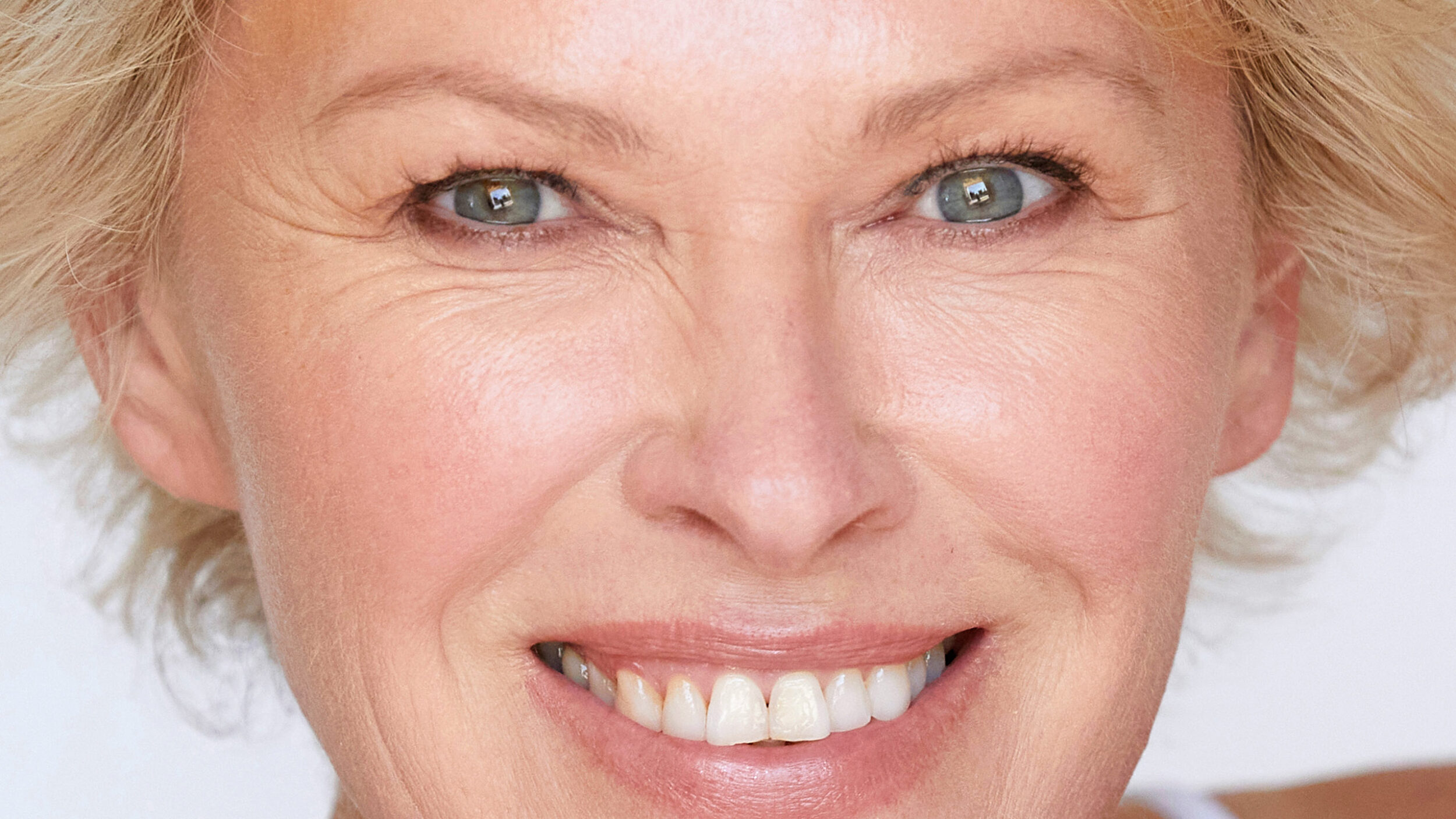 Smiling woman with rejuvenated skin after CO₂ UltraPulse laser skin resurfacing.