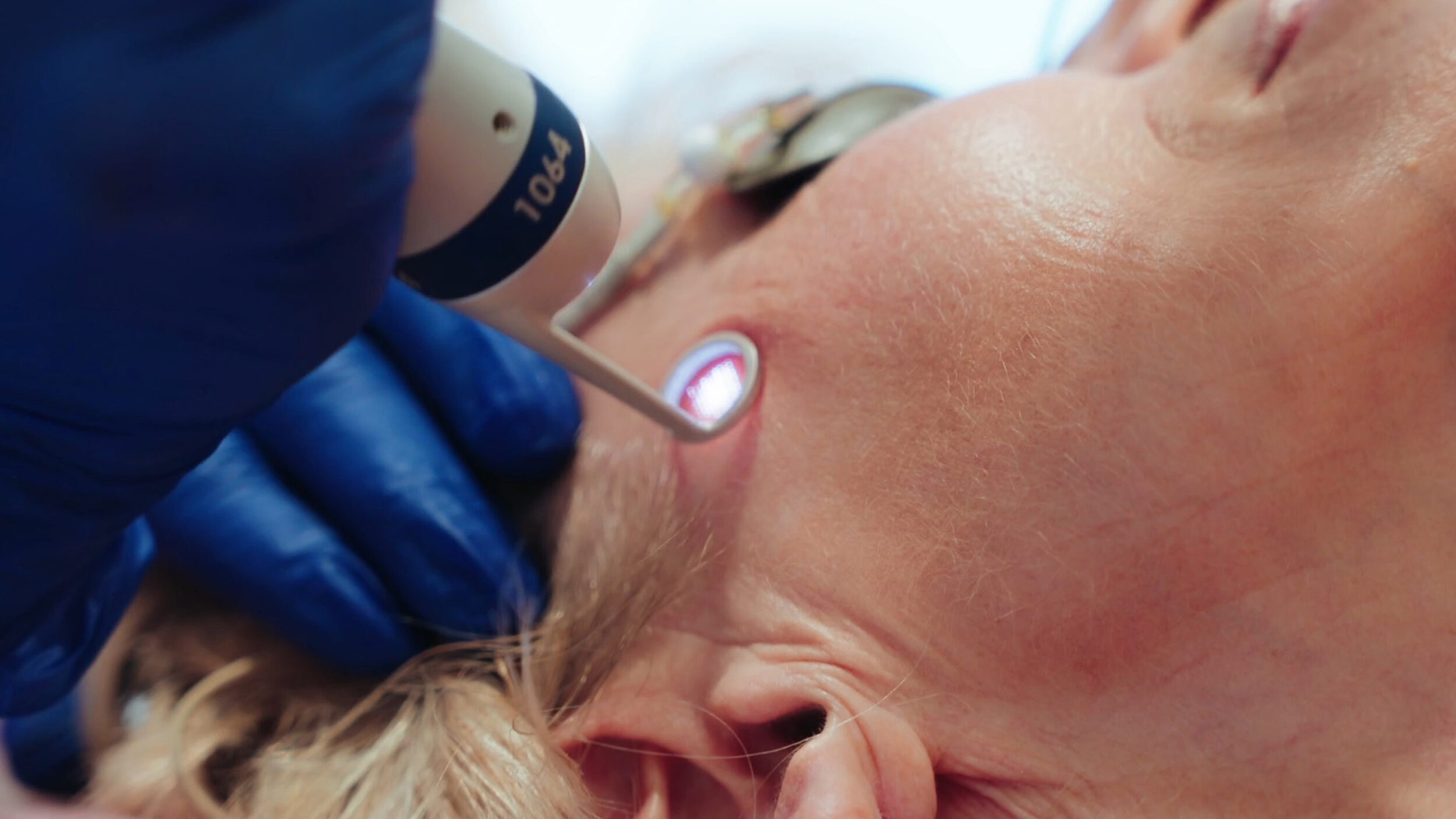 Laser treatment performed on facial skin in a modern dermatology clinic.