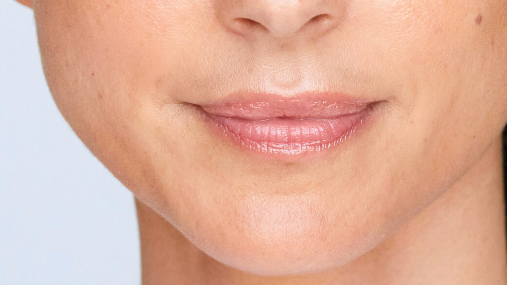 Close-up of naturally enhanced lips after hyaluronic acid lip filler treatment.