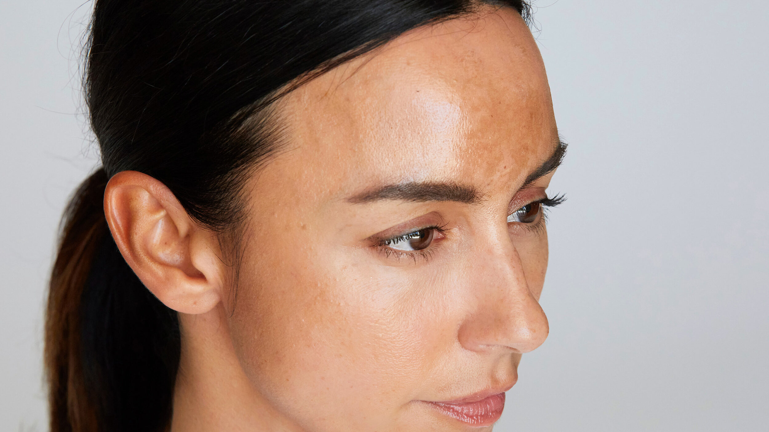 Woman with facial melasma showing pigmentation on the forehead and cheeks.