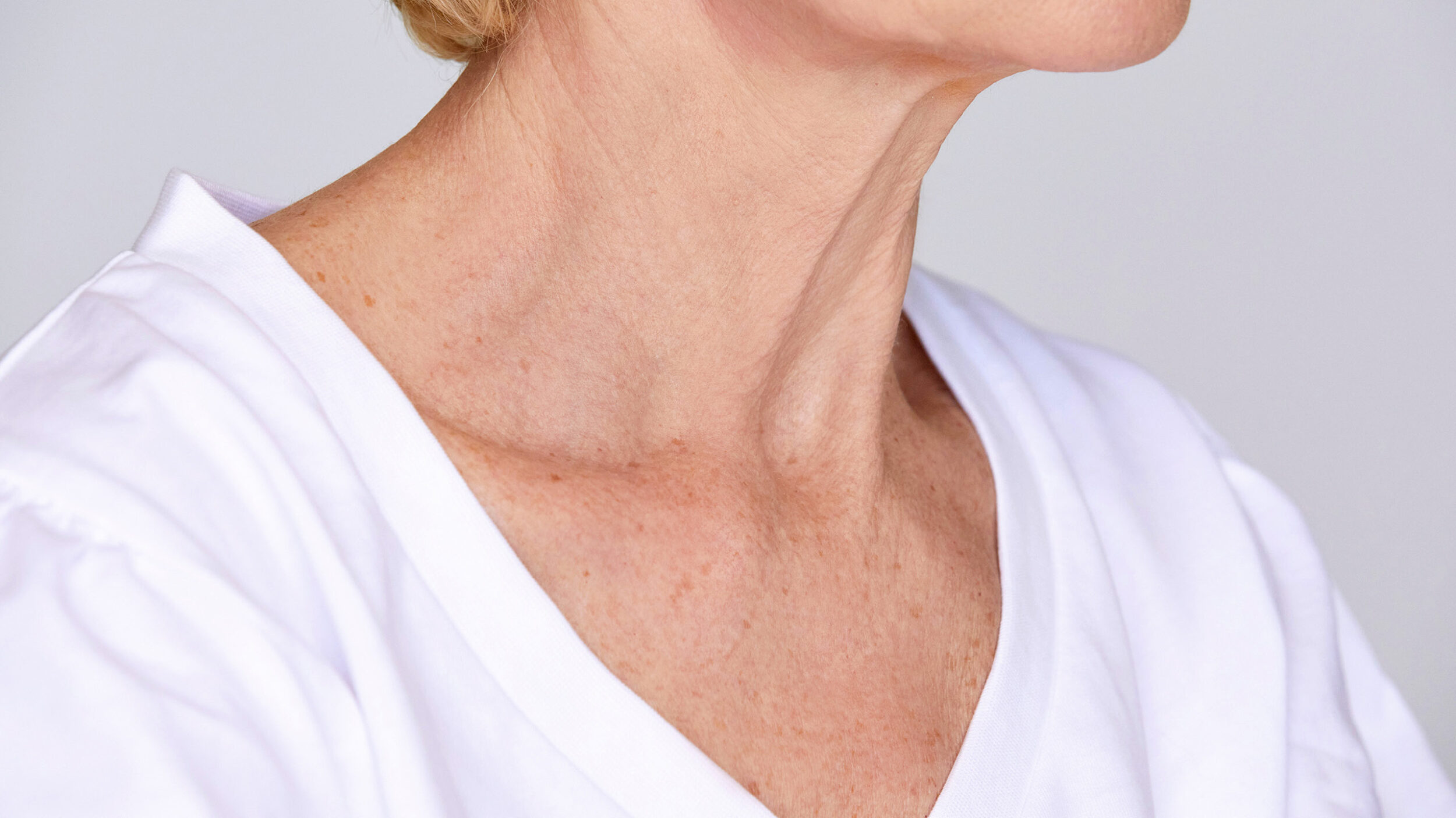 Close-up of the neck showing skin before neck rejuvenation treatment.