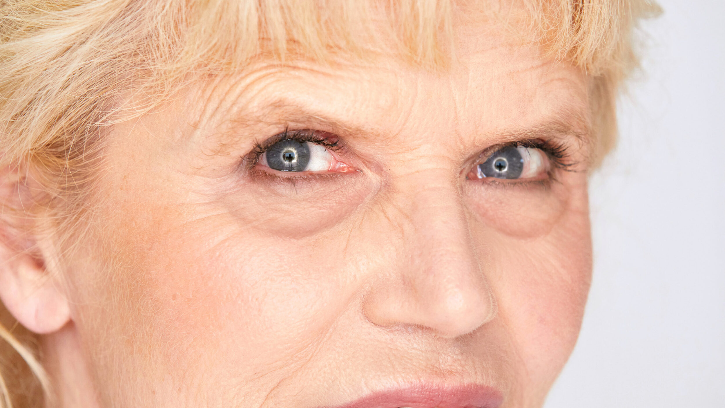 Close-up of mature eyes before treatment for under-eye bags.